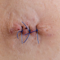 Infected Stitches at Home? Know When It’s Time to Call a Pro