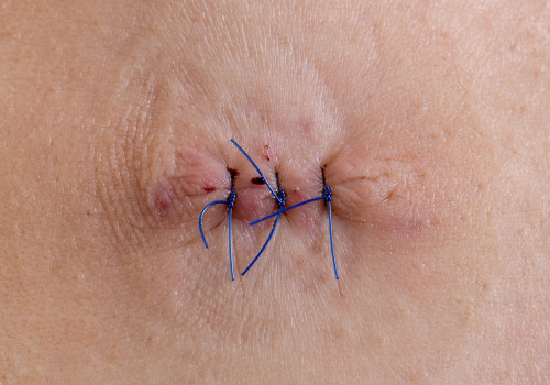 Infected Stitches at Home? Know When It’s Time to Call a Pro