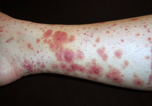 Purpura Simplex and Your Skin What Causes Rashes and Bruises to Appear